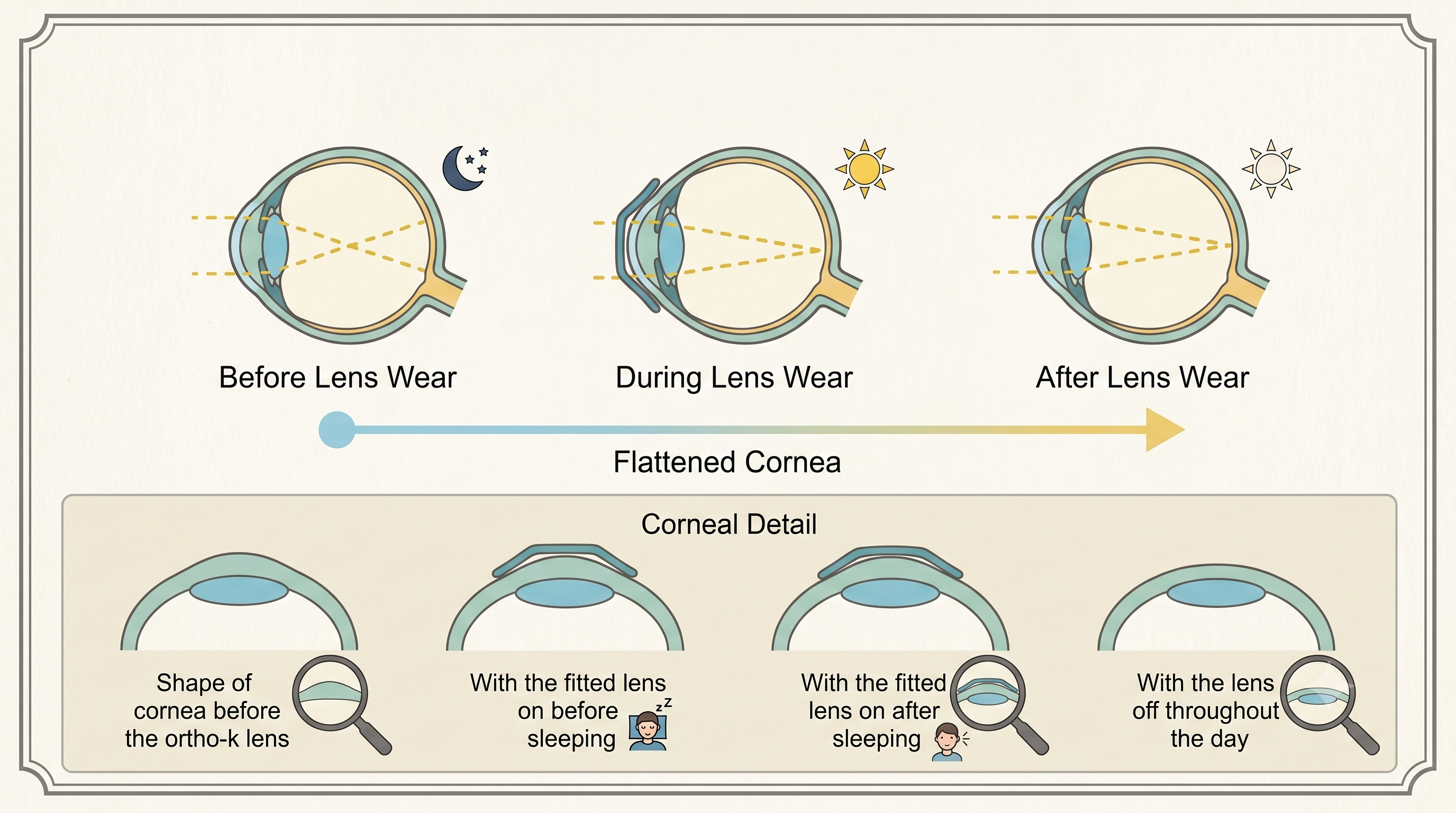 Non-Surgical Ortho-K Lenses for Clear Vision and Myopia Control